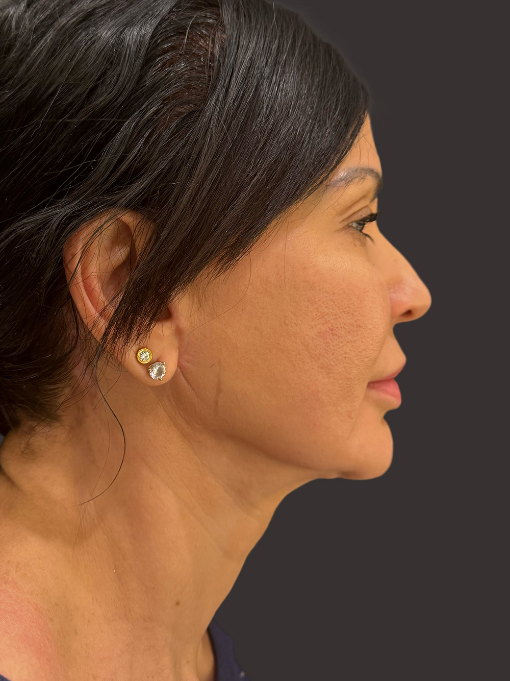 Case--3268-Facelift | After Facelift