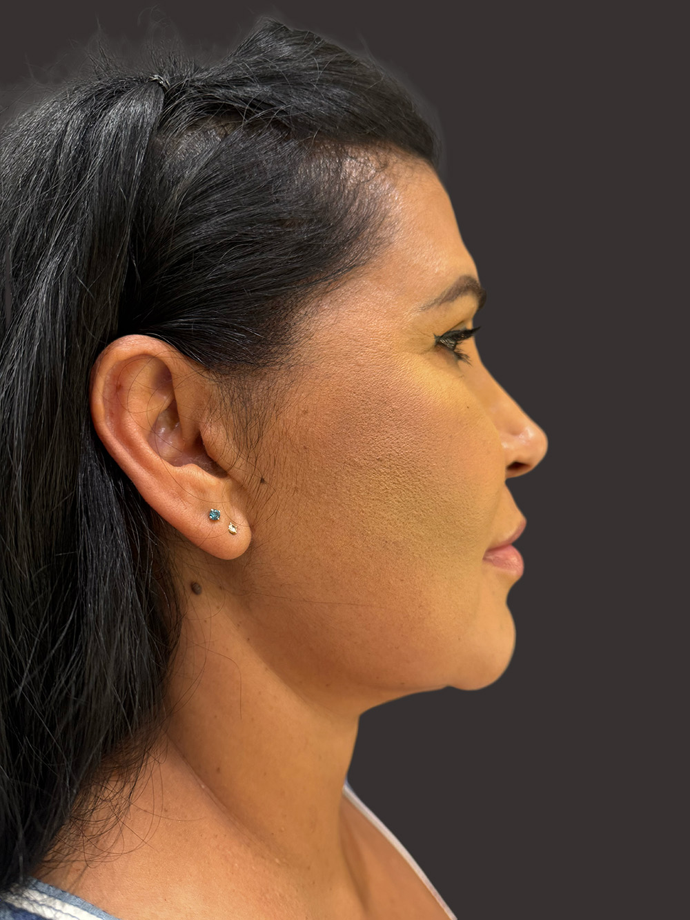 Case--7590-Facelift | After Facelift