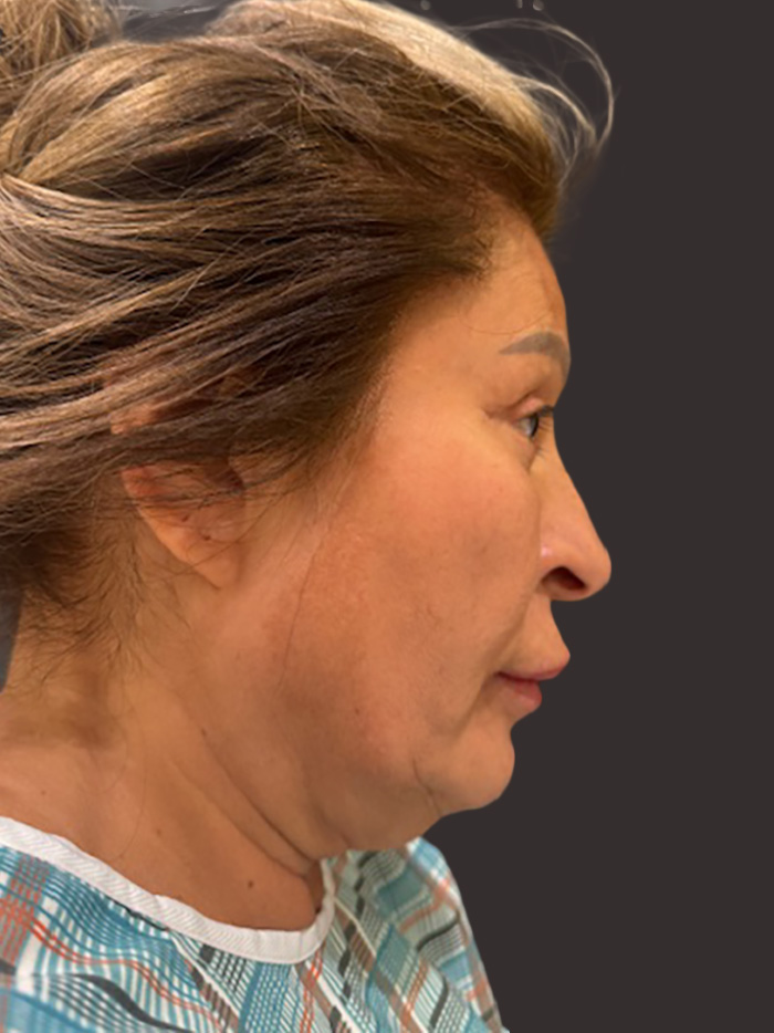 Case--8009-Facelift | Before Facelift