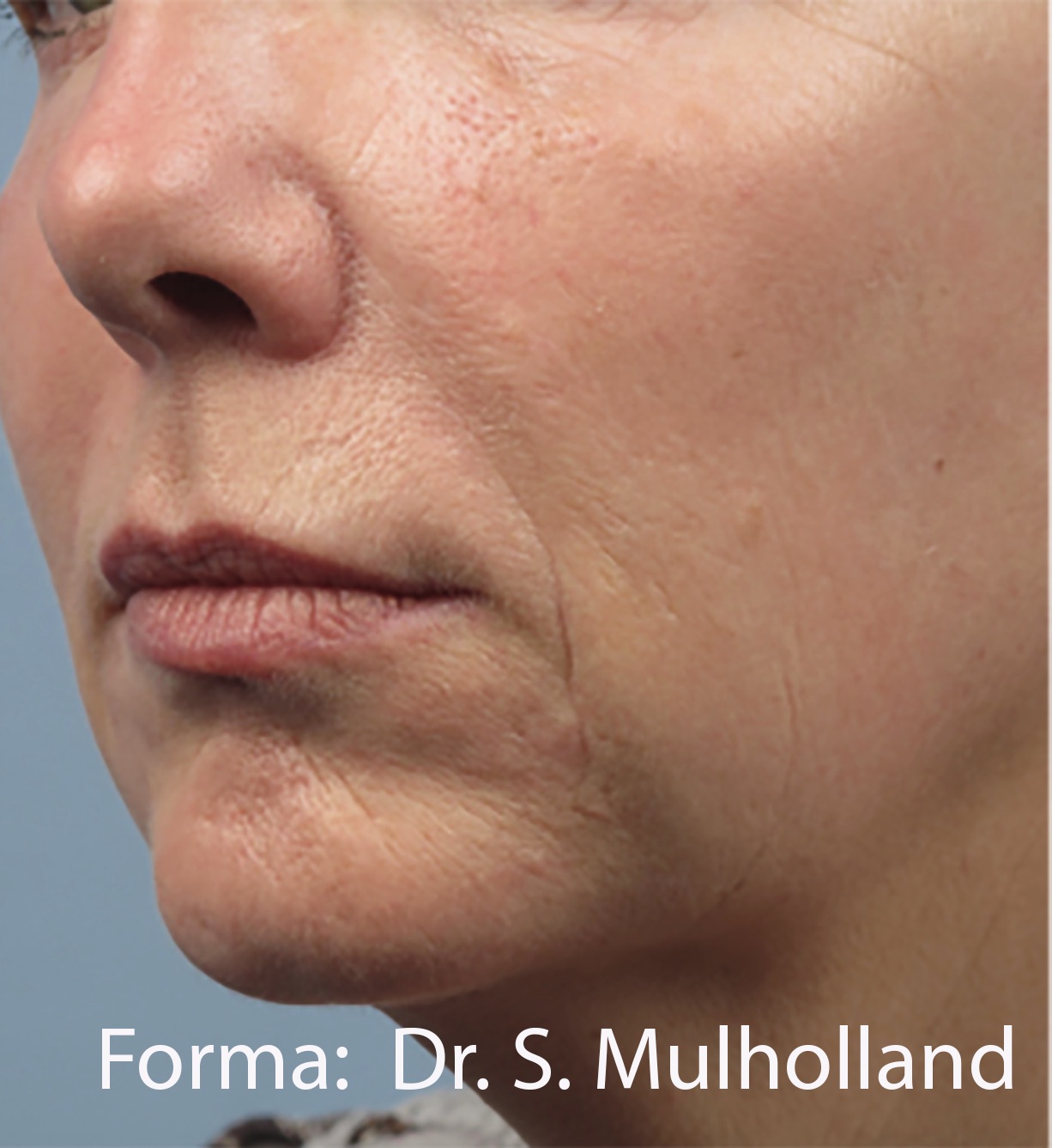 Case--9191-Forma | After Forma