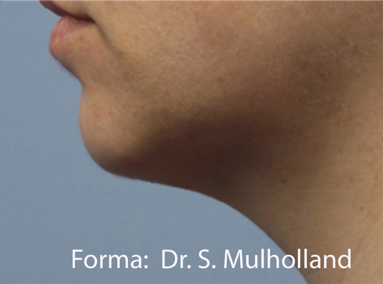 Case--6972-Forma | After Forma