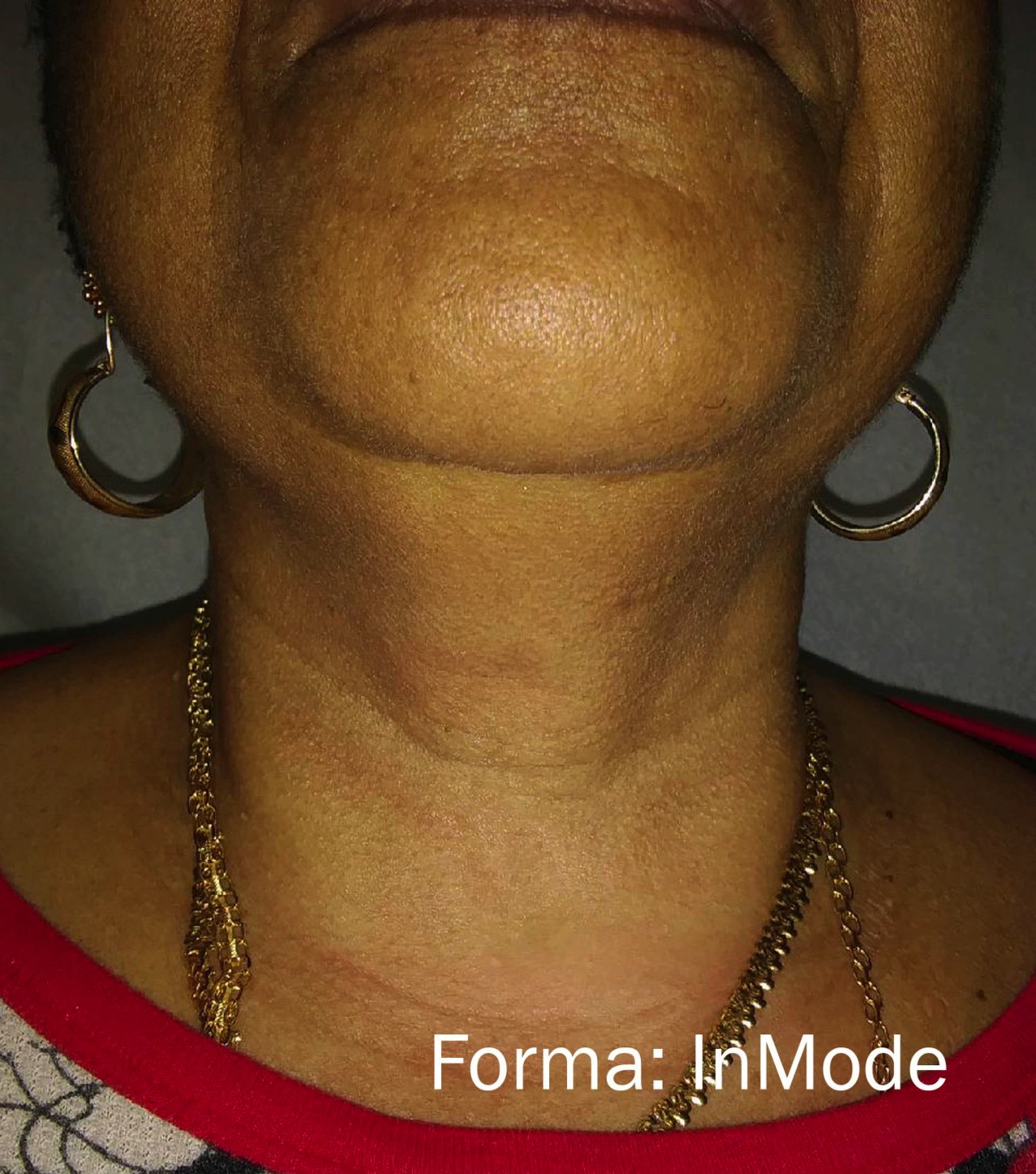 Case--7926-Forma | After Forma