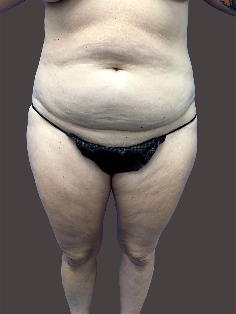 Case--1944-Tummy-Tuck | Before Body