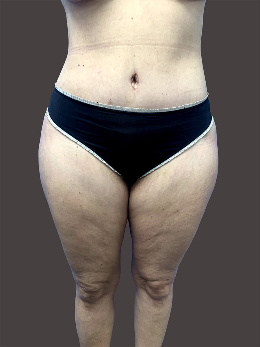 Case--1944-Tummy-Tuck | After Body