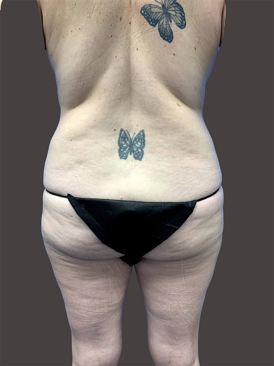 Case--4348-Liposuction | Before Body