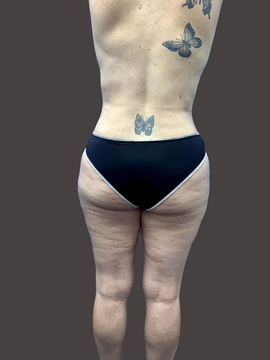 Case--4348-Liposuction | After Body