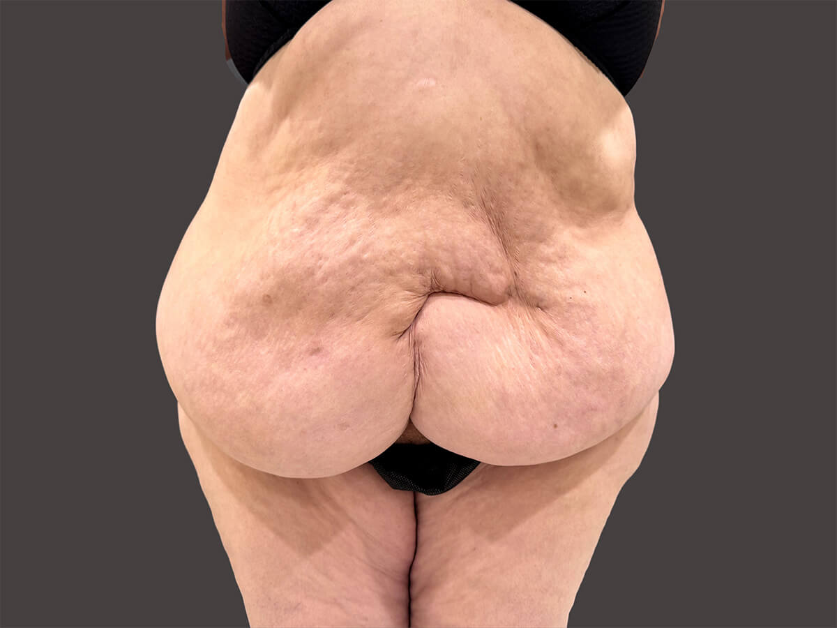 Case--4703-Tummy-Tuck | Before Body