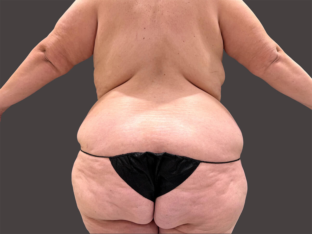 Case--9174-Liposuction | Before Body