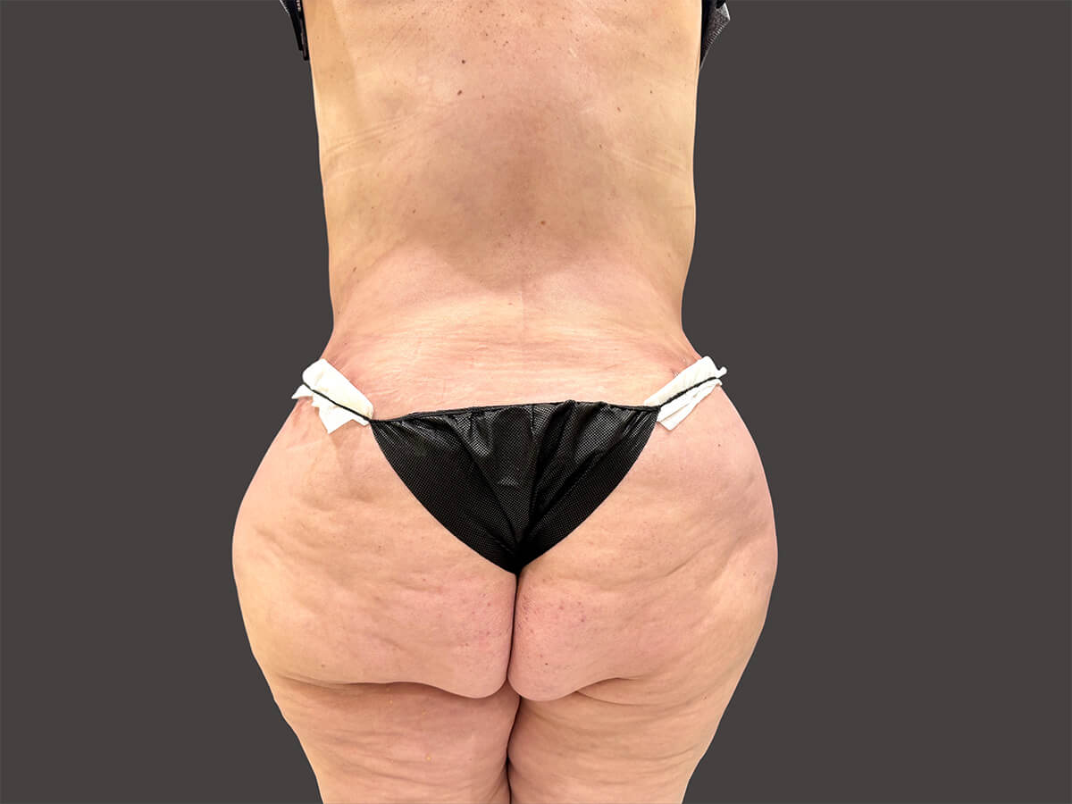 Case--9174-Liposuction | After Body