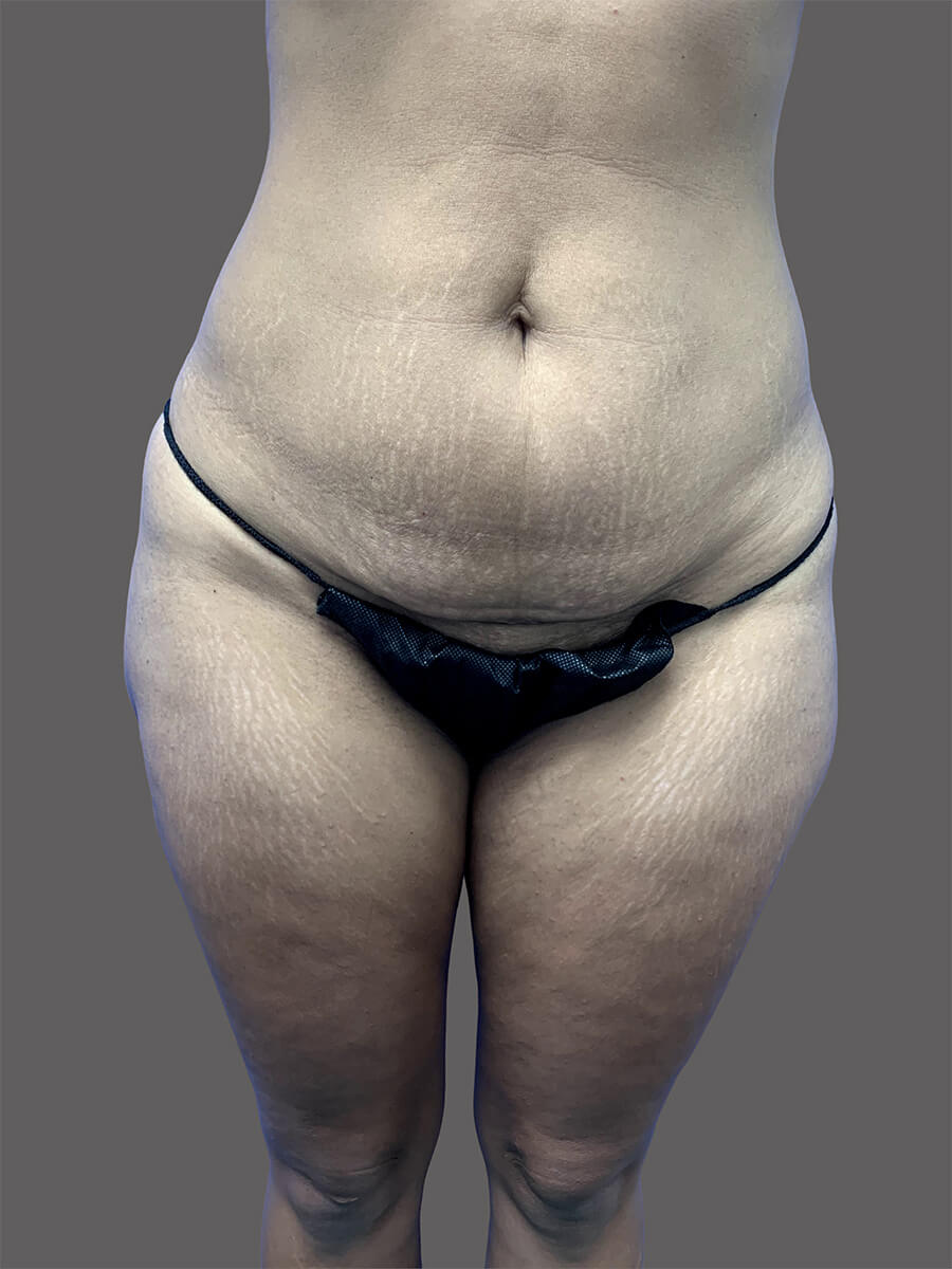 Case--9388-Tummy-Tuck | Before Body