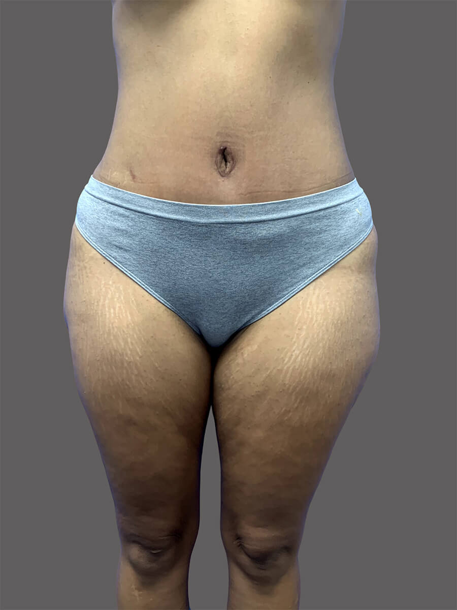 Case--9388-Tummy-Tuck | After Body