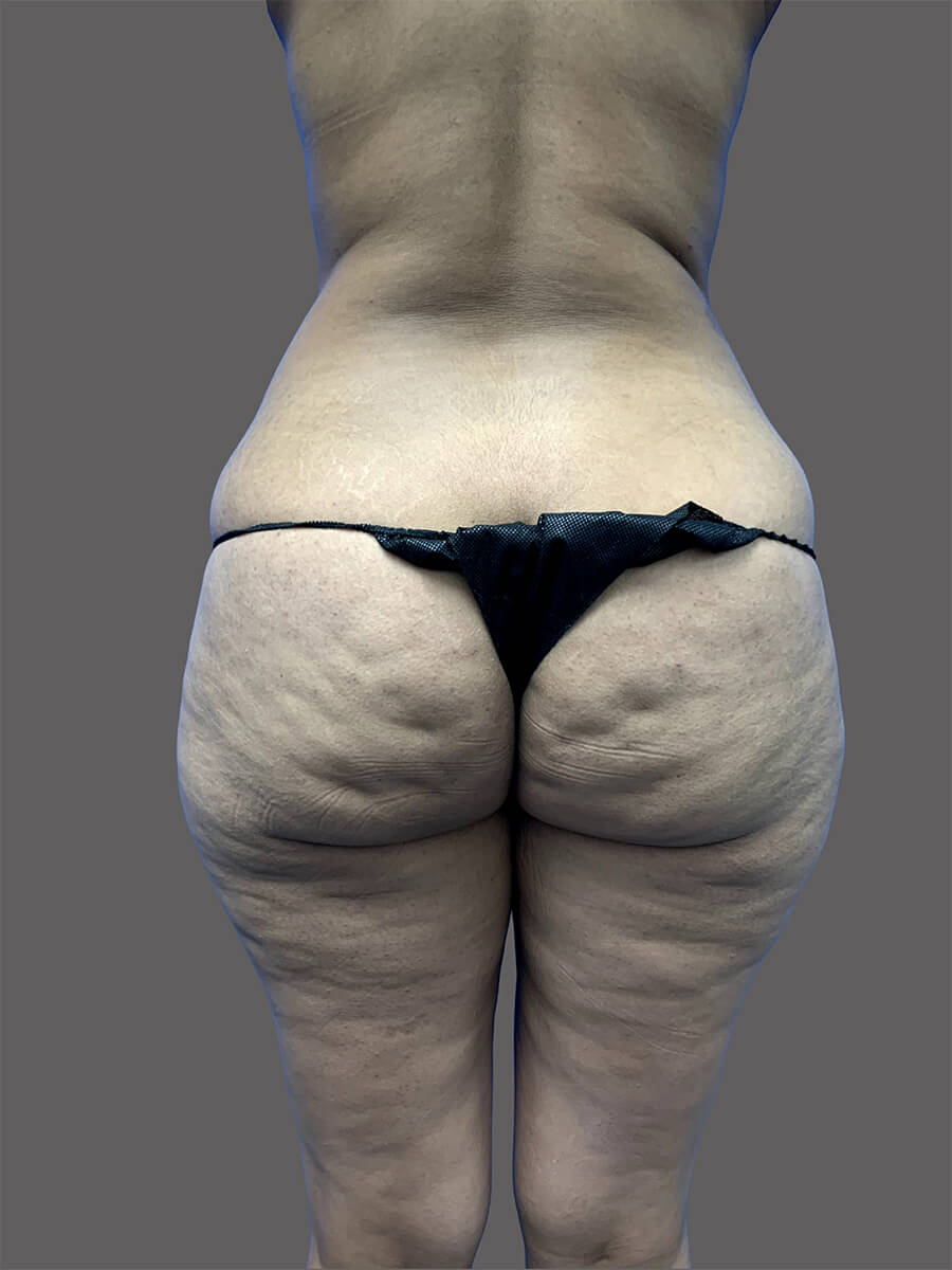Case--1609-Liposuction | Before Body