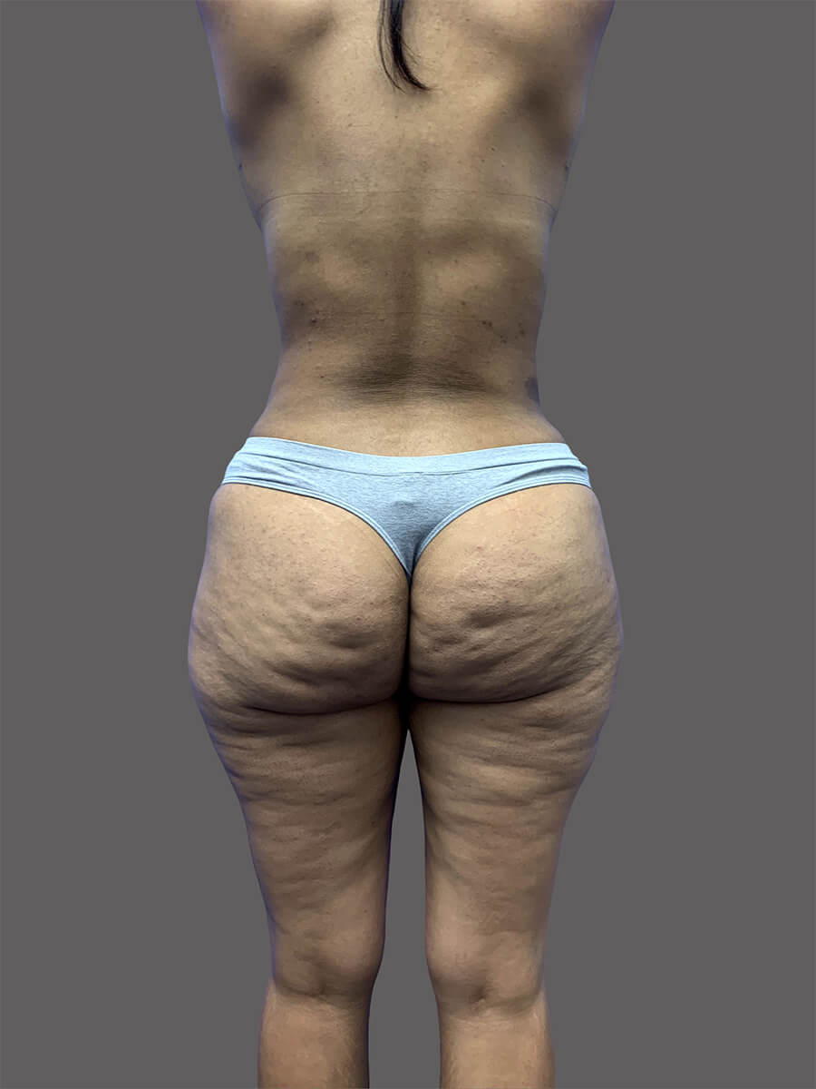 Case--1609-Liposuction | After Body