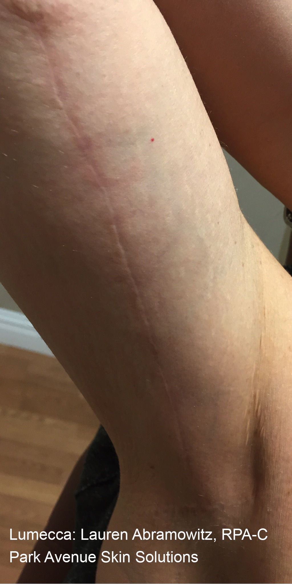 Case--1429-Lumecca-IPL | After Lumecca IPL