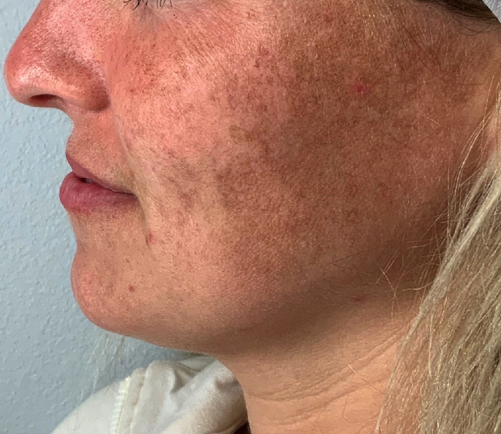 Case--6473-Lumecca-IPL | Before Lumecca IPL