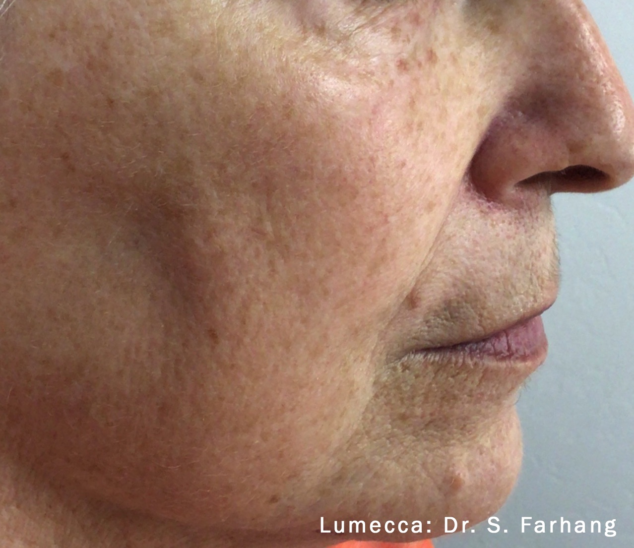 Case--2108-Lumecca-IPL | After Lumecca IPL