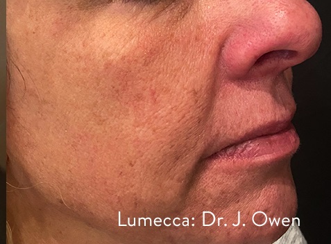 Case--8900-Lumecca-IPL | After Lumecca IPL