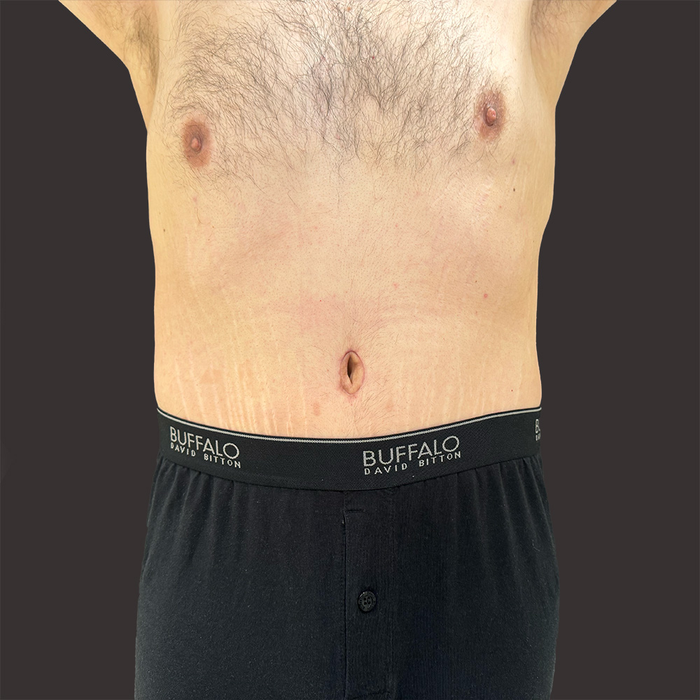 Case--7506-Male-Surgery | After Male Surgery