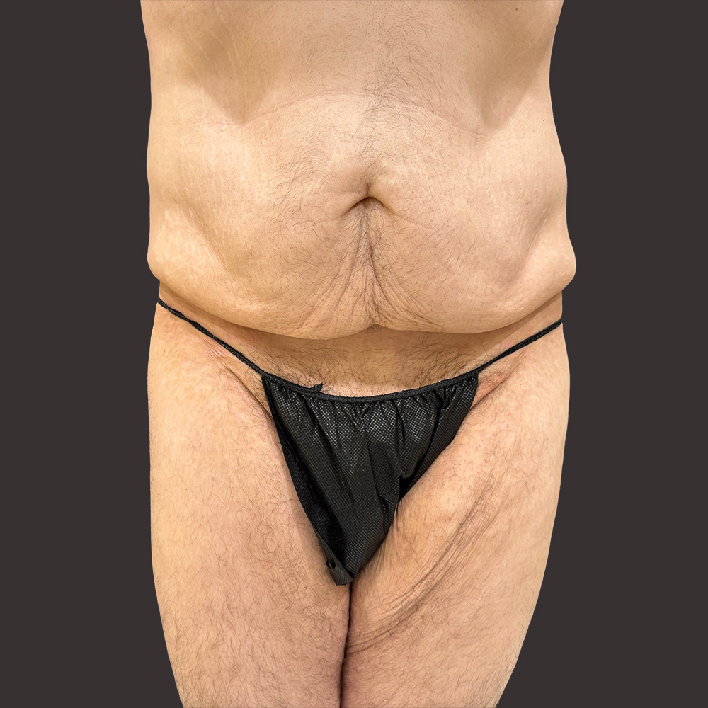 Case--7506-Male-Surgery | Before Male Surgery