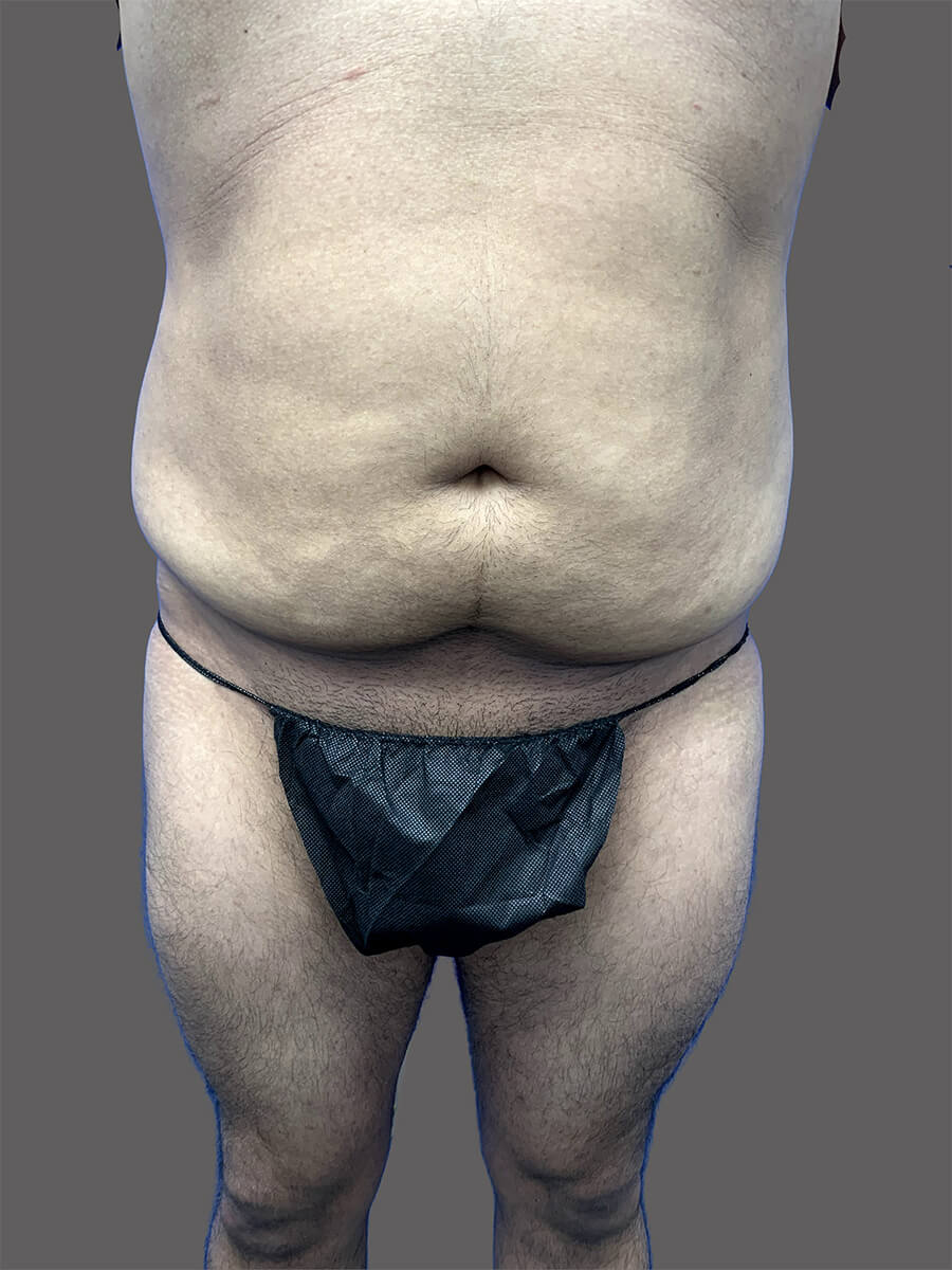 Case--3151-Tummy-Tuck | Before Body