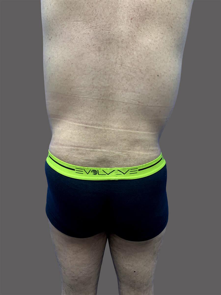 Case--1604-Liposuction | After Body