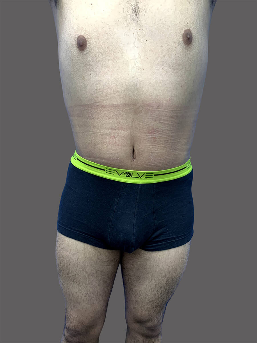 Case--3151-Tummy-Tuck | After Body