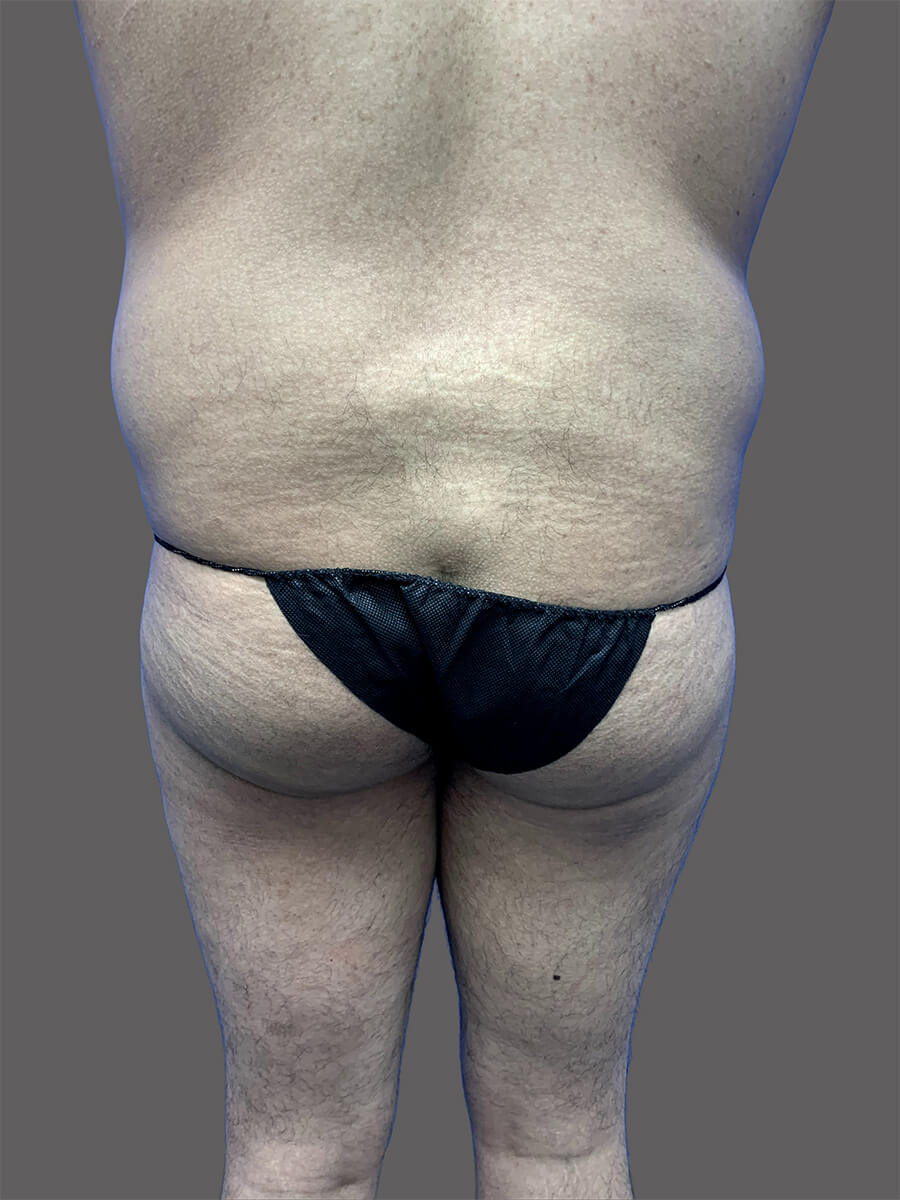 Case--1604-Liposuction | Before Body