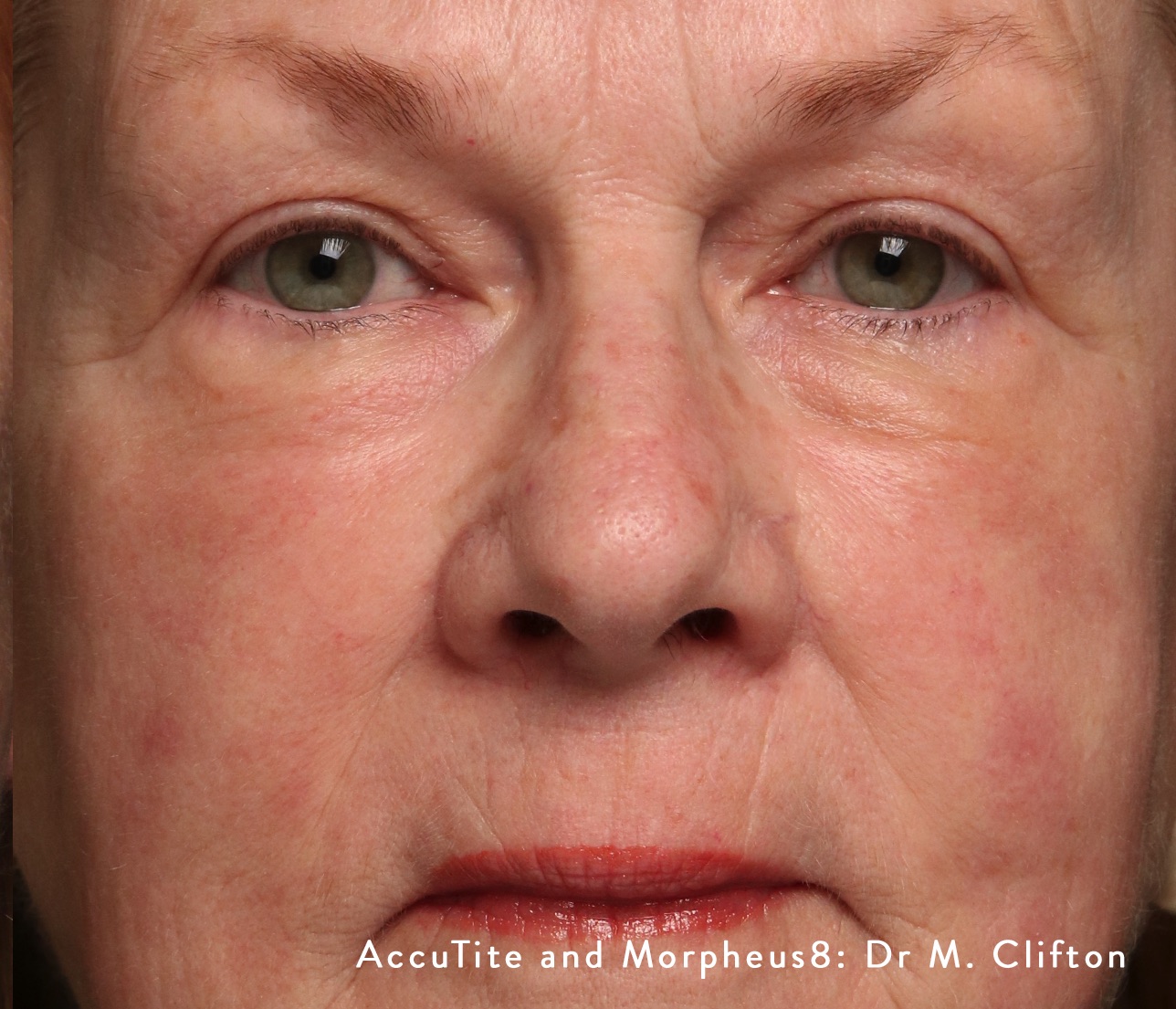 Case--1488-Morpheus8 | After Morpheus8