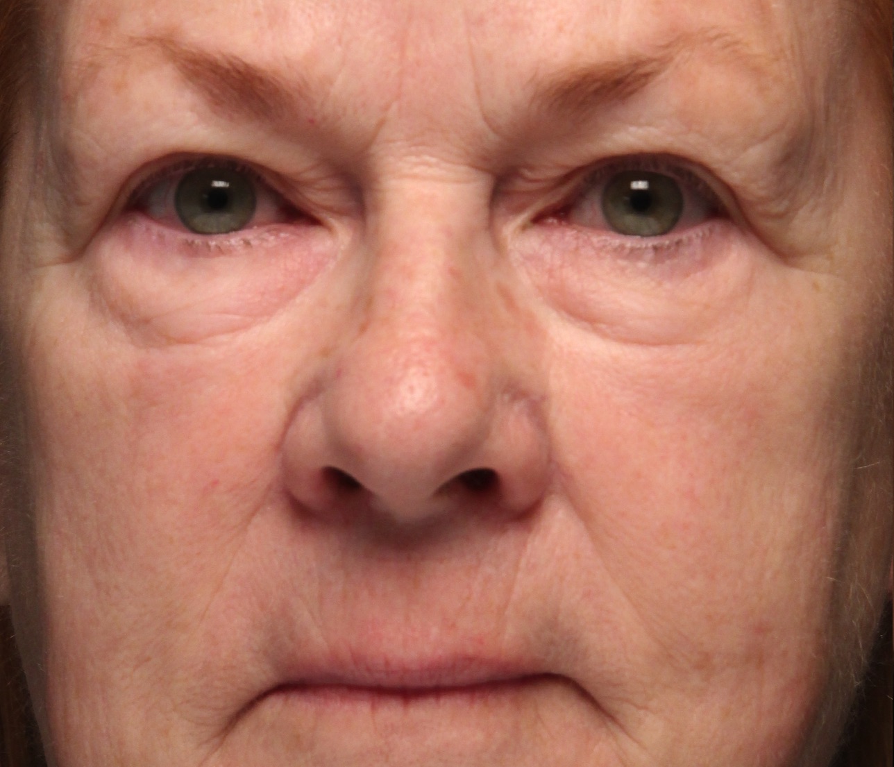 Case--1488-Morpheus8 | Before Morpheus8