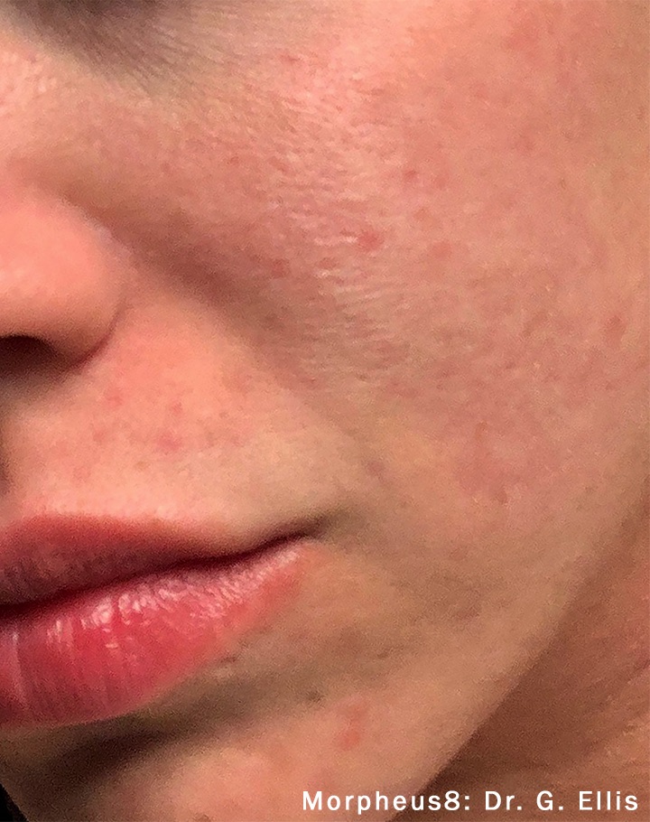 Case--6266-Morpheus8 | After Morpheus8