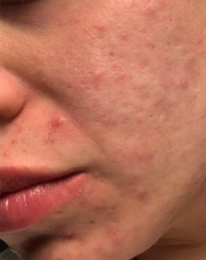 Case--6266-Morpheus8 | Before Morpheus8