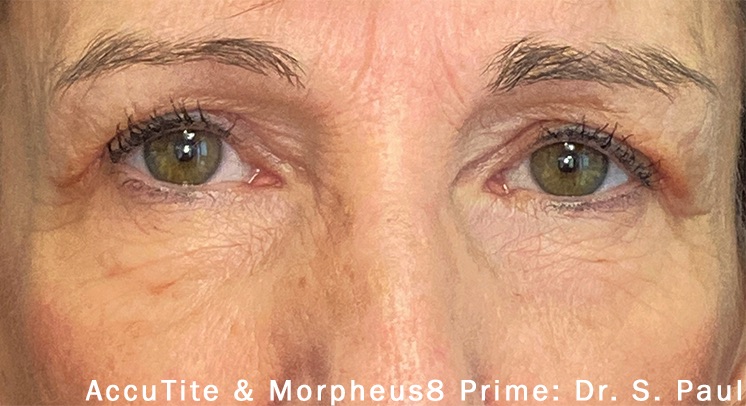 Case--9899-Morpheus8 | After Morpheus8