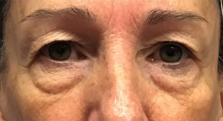 Case--9899-Morpheus8 | Before Morpheus8