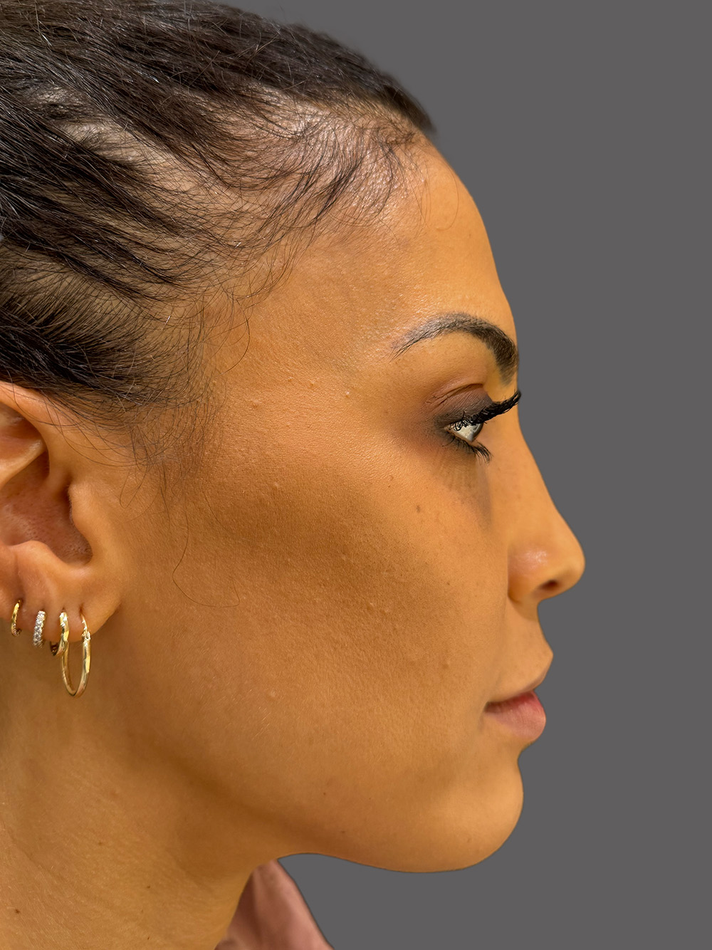 Case--7673-Rhinoplasty | After Rhinoplasty