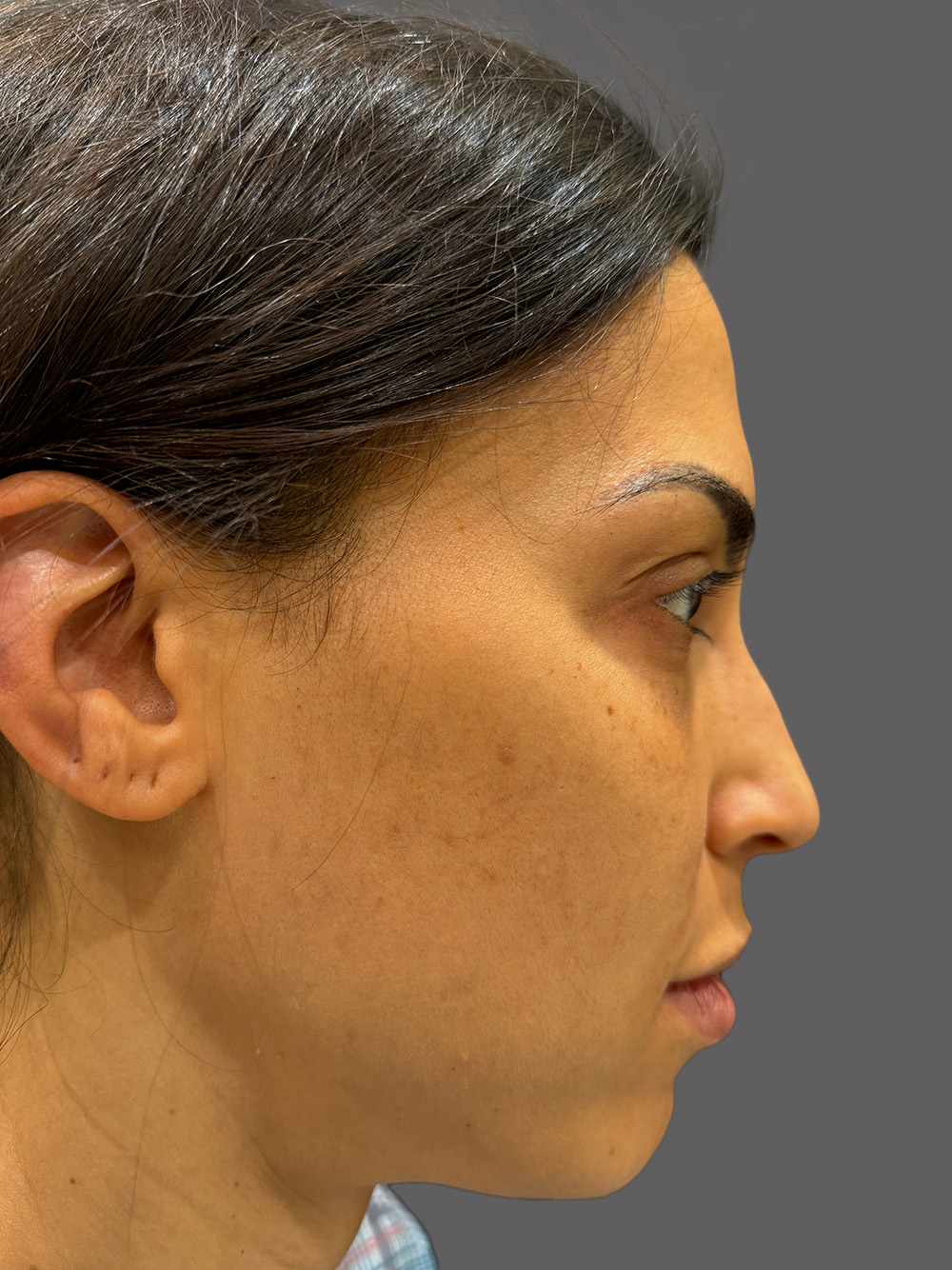 Case--7673-Rhinoplasty | Before Rhinoplasty