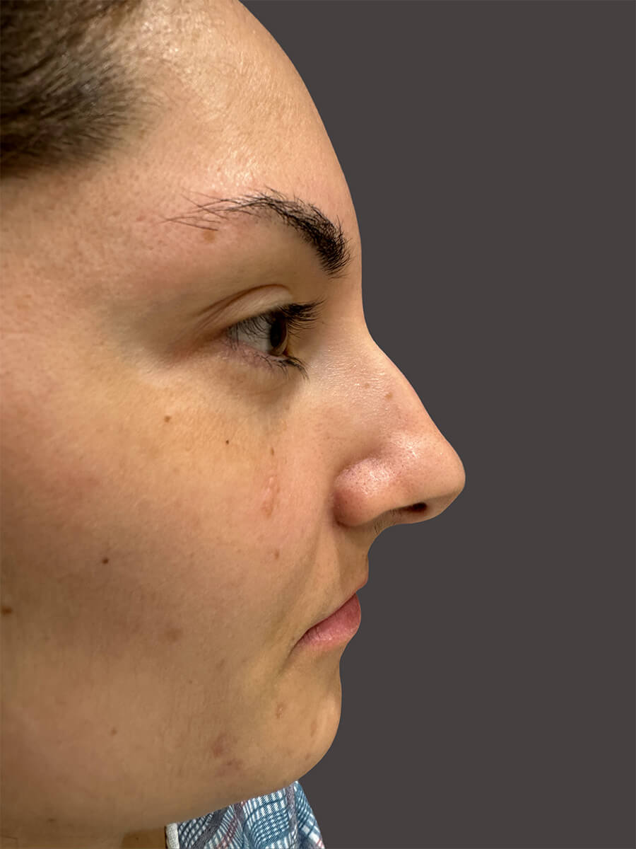 Case--6679-Rhinoplasty | Before Rhinoplasty