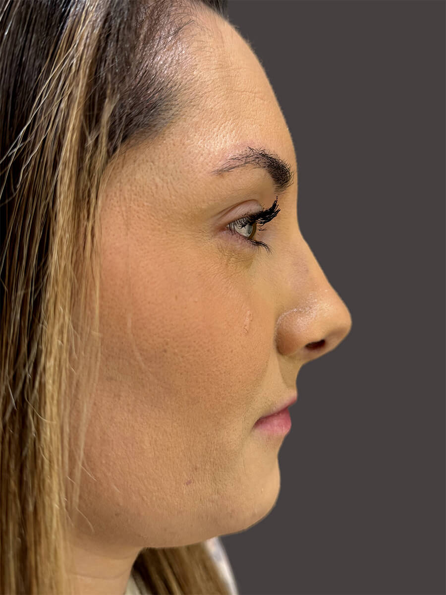 Case--6679-Rhinoplasty | After Rhinoplasty