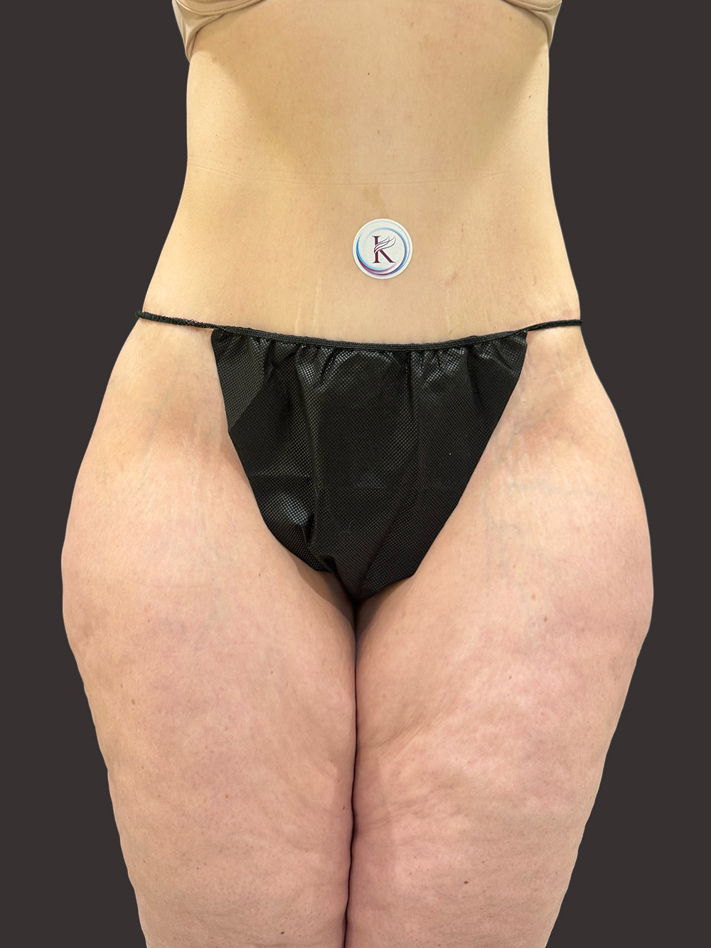 Case--6899 | After Body