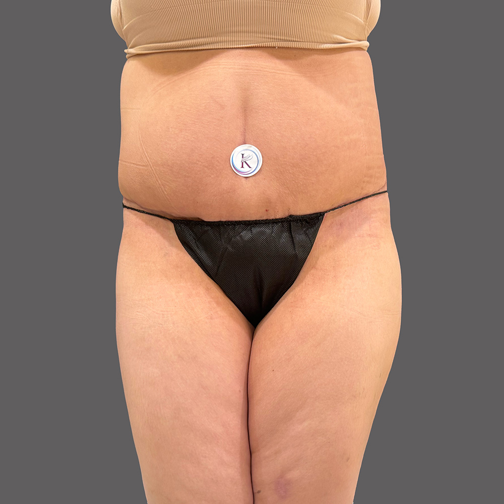 Case--1339-Tummy-Tuck | After Body