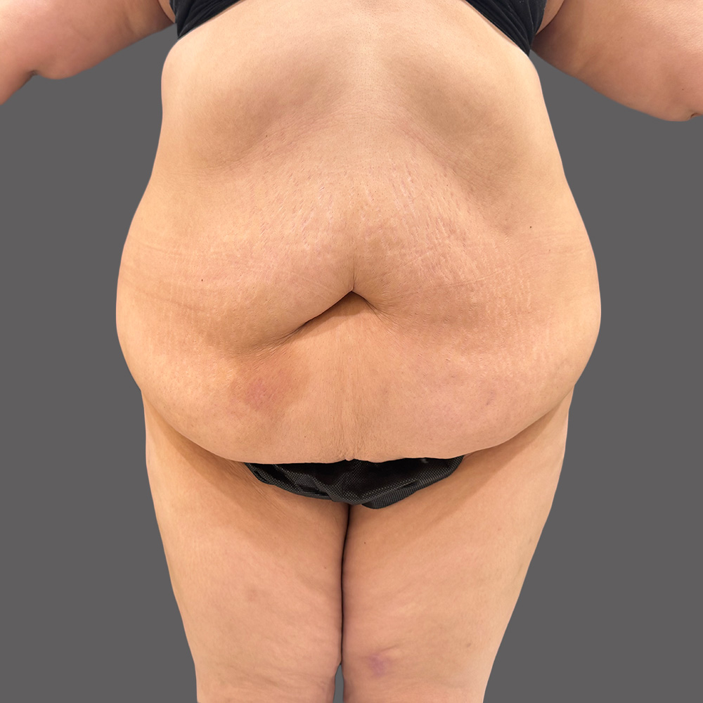 Case--1339-Tummy-Tuck | Before Body