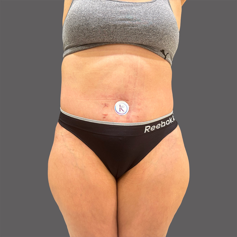 Case--8539-Liposuction | After Body