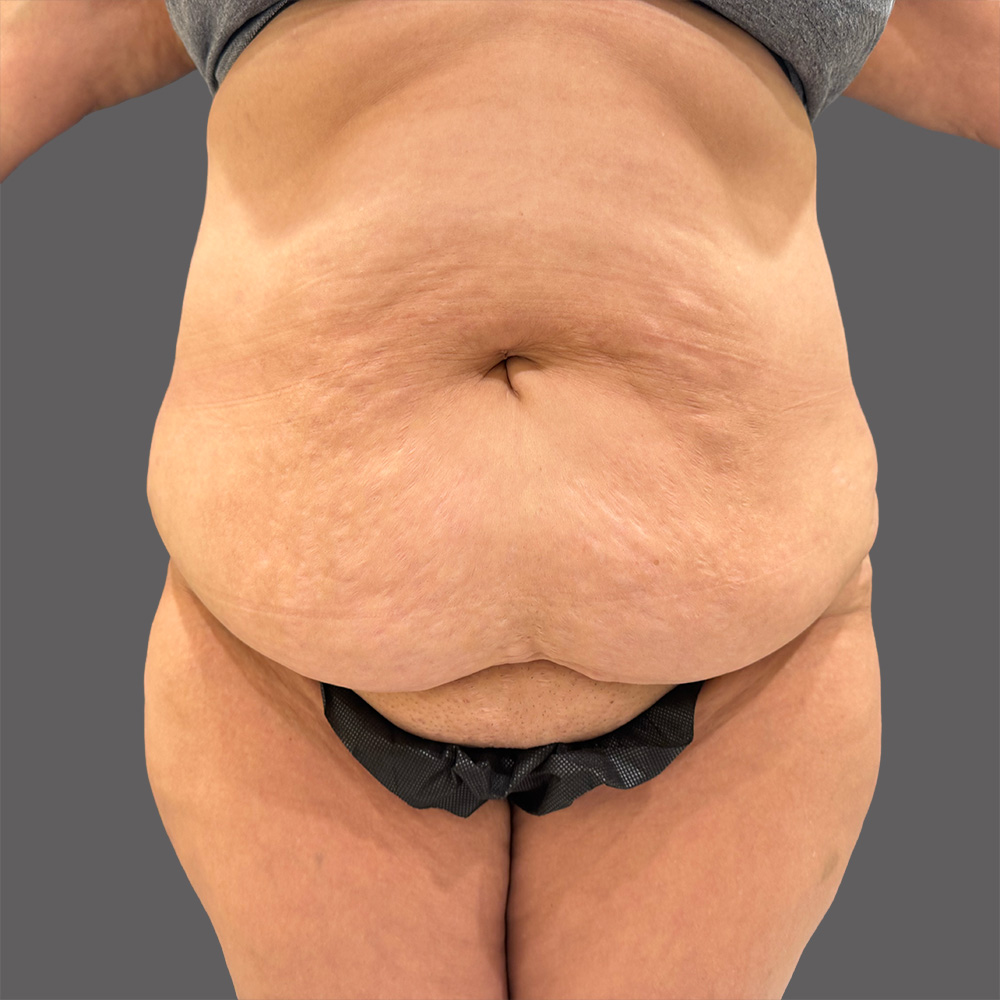 Case--8539-Liposuction | Before Body