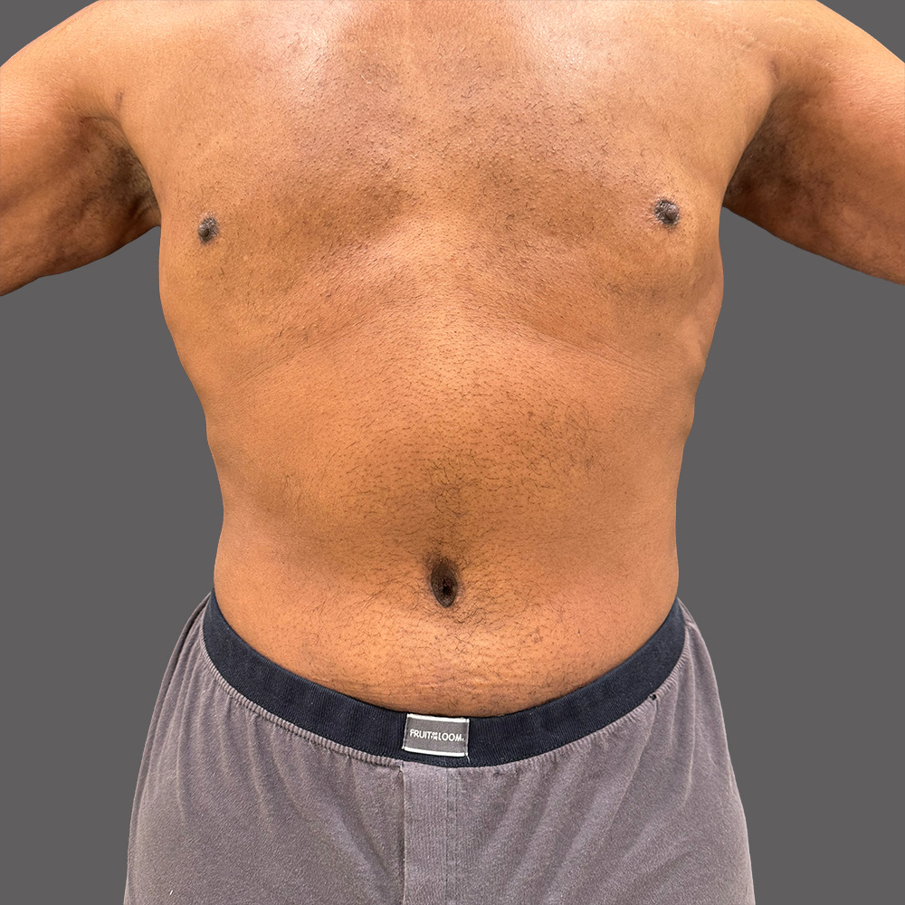 Case--8070-Tummy-Tuck | After Body
