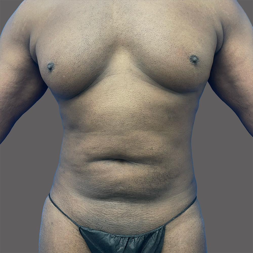 Case--8070-Tummy-Tuck | Before Body