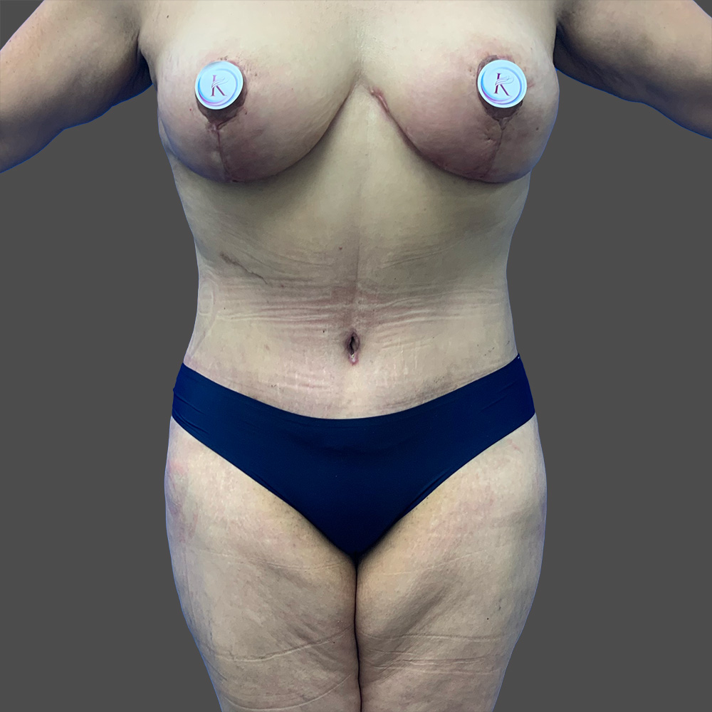 Case--7752-Tummy-Tuck | After Body