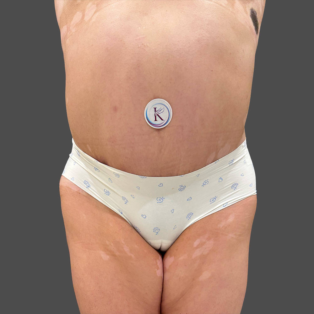 Case--1520-Tummy-Tuck | After Body