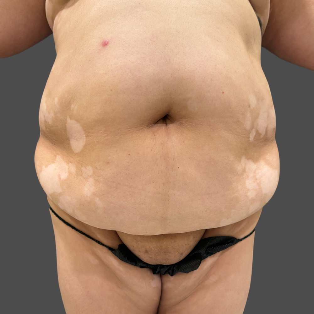 Case--1520-Tummy-Tuck | Before Body