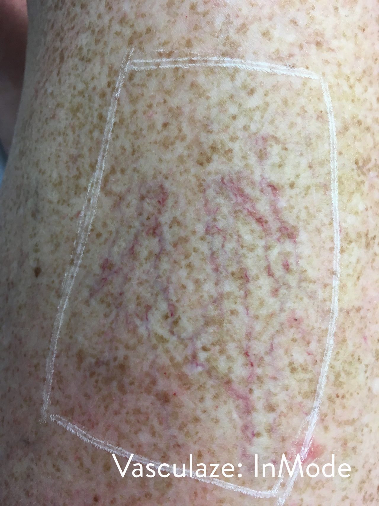 Case--5606-Vasculaze | After Vasculaze