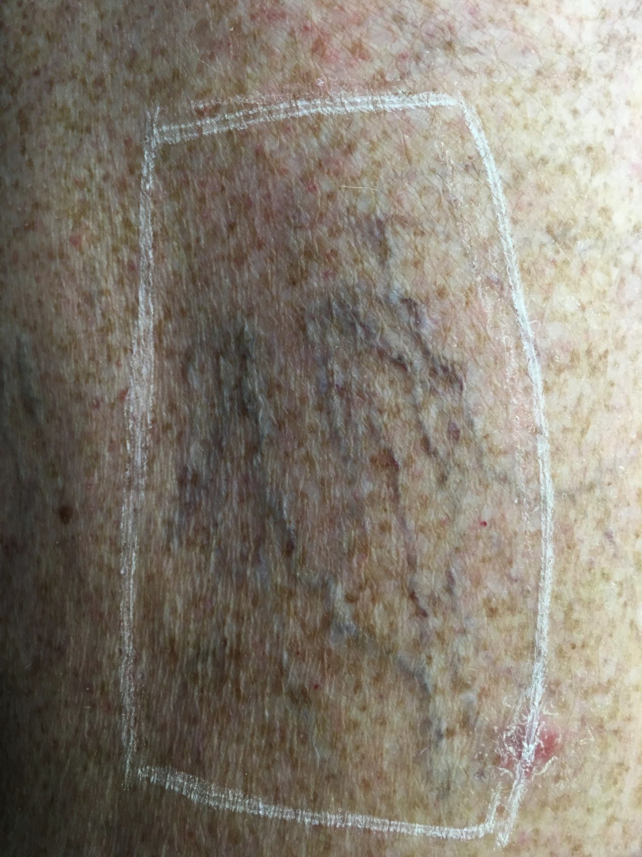 Case--5606-Vasculaze | Before Vasculaze